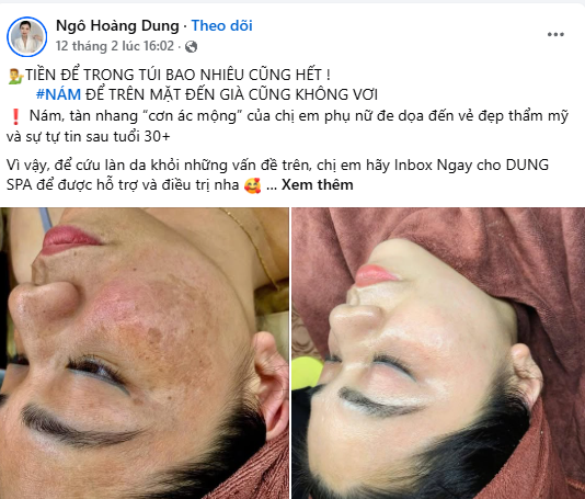 Mẫu content trị nám gây ấn tượng mạnh mẽ với khách hàng